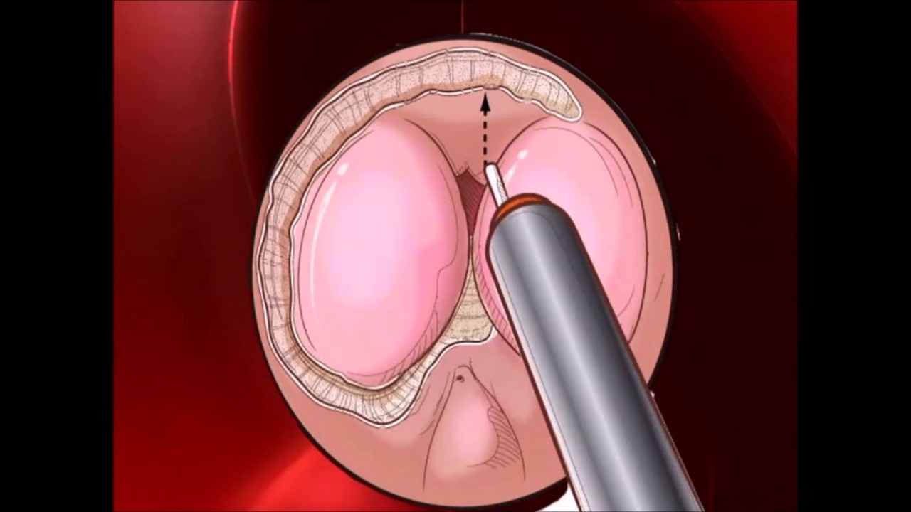 HoLep procedure