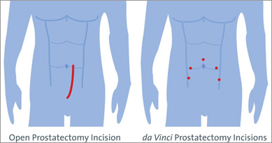 prostate incision