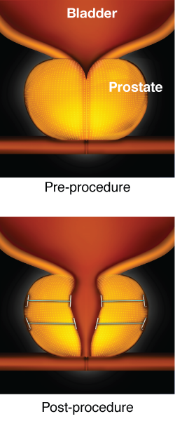 The Urolift System For Bph Advanced Urology Institute At Titus