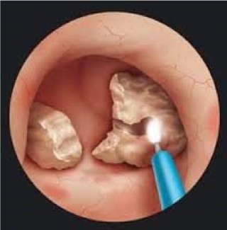 kidney stones
