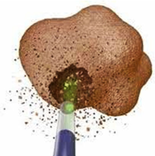 kidney stone dusting